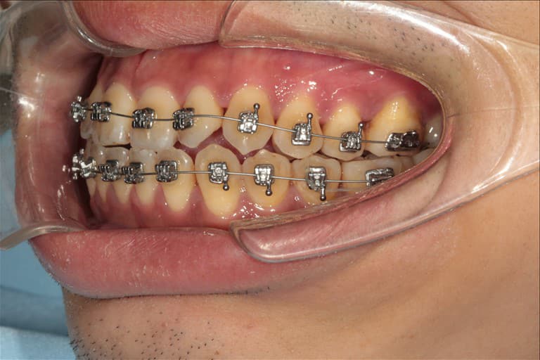 quy trình cơ bản trong niềng răng