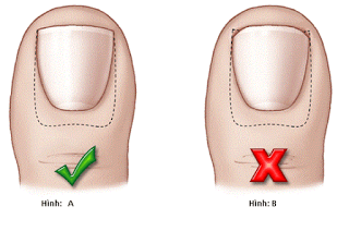 Hình A: Cắt móng chân đúng cách. Hình B: Cắt móng chân SAI cách (không được vuốt thon, tròn hay nhọn phần móng; đặc biệt là 2 bên khoé móng).