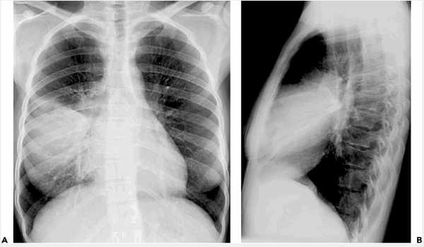 Cách nhận biết viêm phổi là đi chụp X- quang 