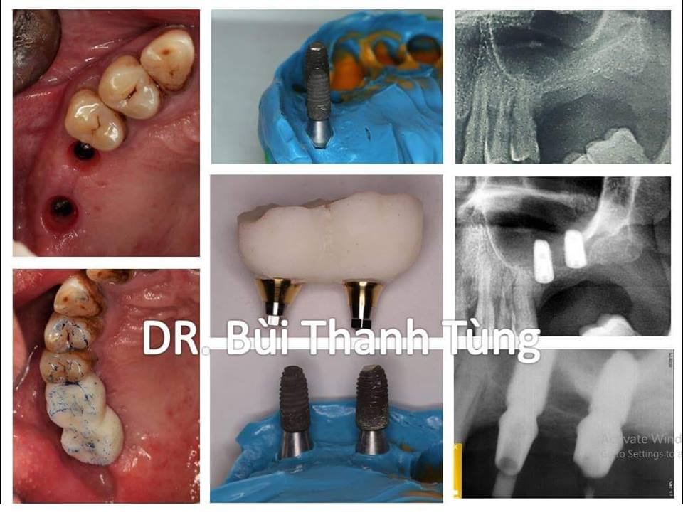 Kĩ thuật Implant trong nha khoa- Trồng răng implant ở đâu tốt hà nội, tphcm