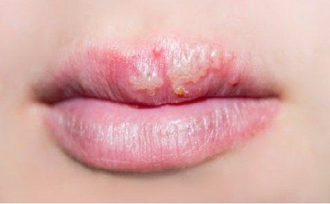 Herpes môi ở trẻ em có lây không?