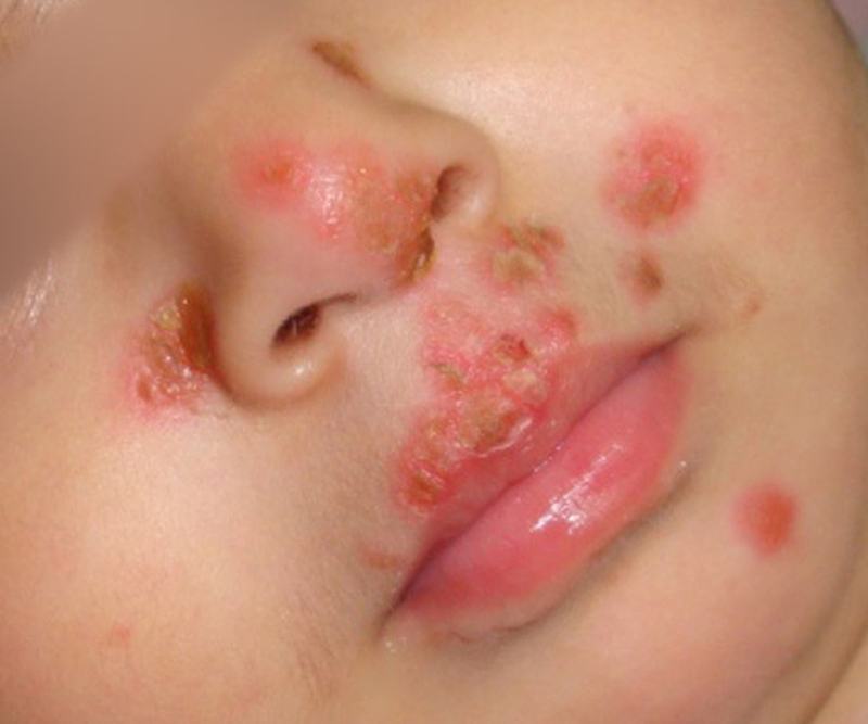 Herpes môi ở trẻ em có lây không