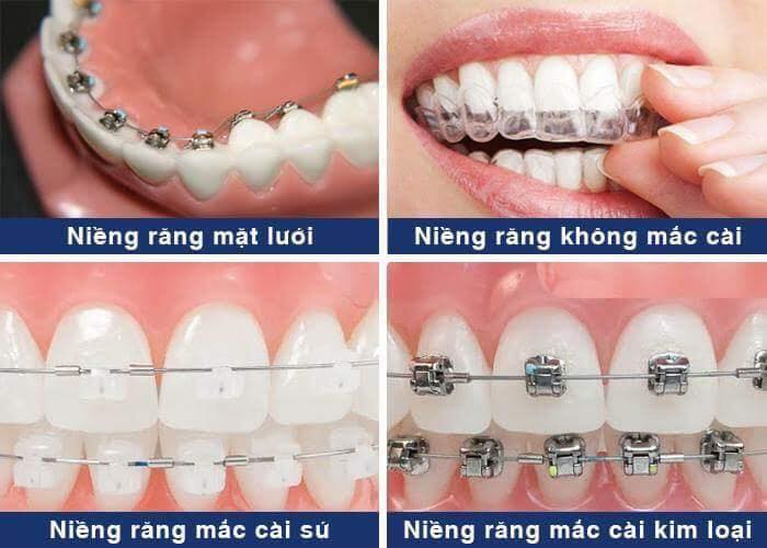 Kinh nghiệm niềng răng, niềng răng ở đâu, bác sĩ nào giỏi HN - SG