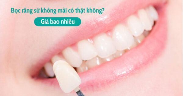 Bọc răng sứ không mài có thật không? Giá bao nhiêu