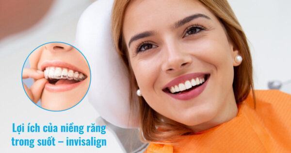 Lợi ích của niềng răng trong suốt – invisalign