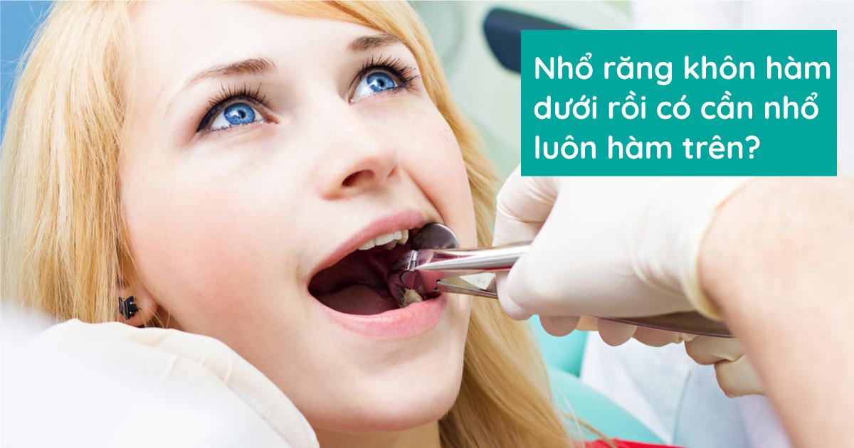 Nhổ răng khôn hàm dưới rồi có cần nhổ luôn hàm trên?