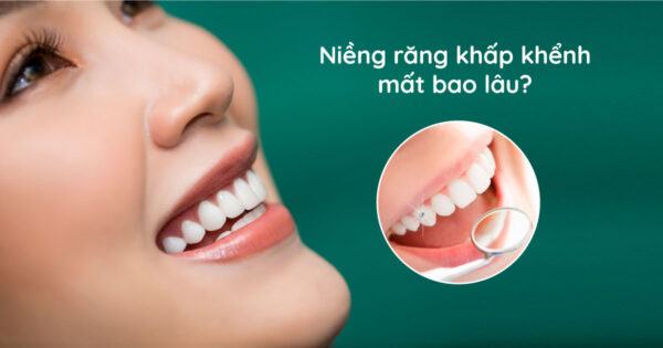 Niềng răng khấp khểnh mất bao lâu?