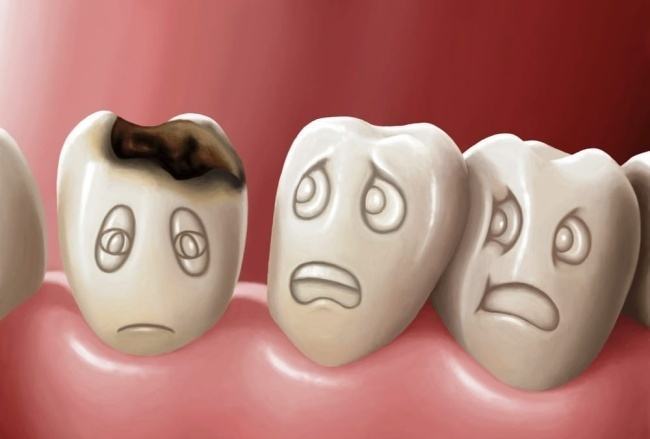 Bệnh sâu răng và cách chữa sâu răng hiệu quả