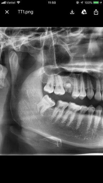 Chia sẻ kinh nghiệm đi nhổ răng khôn bằng bảo hiểm y tế ở Răng Hàm Mặt TPHCM