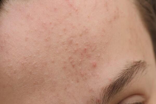 Quy trình dưỡng da dành cho da có mụn ẩn, lỗ chân lông to, da không đều màu.
