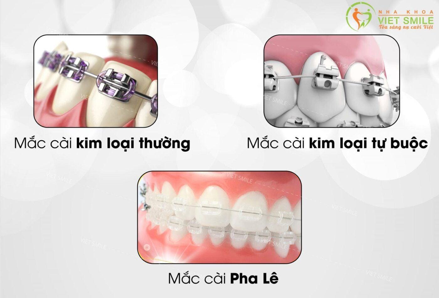 niềng răng 1 hàm