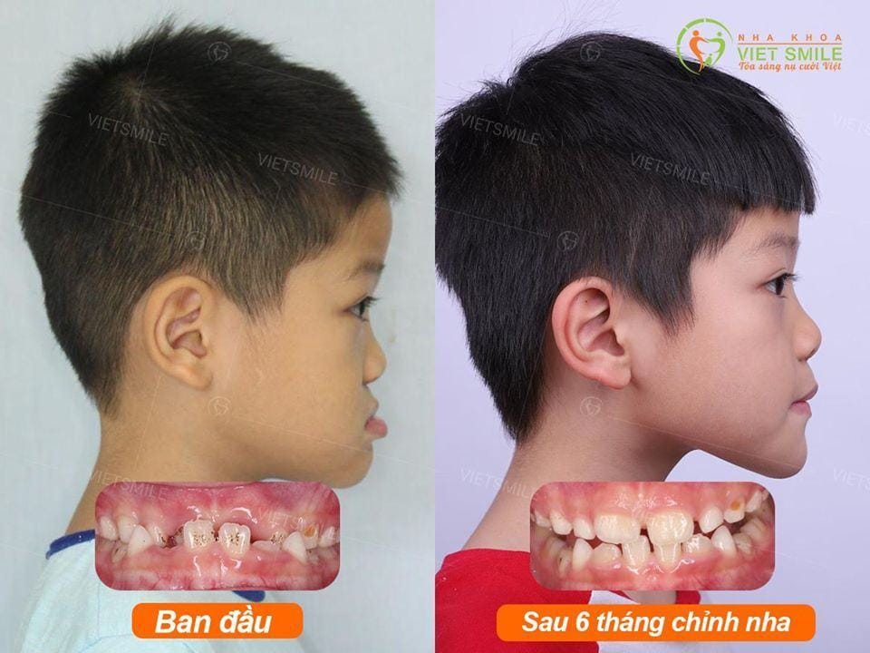 nieng rang 1 ham