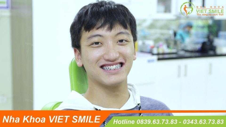 niềng răng 1 hàm giá bao nhiêu tiền?