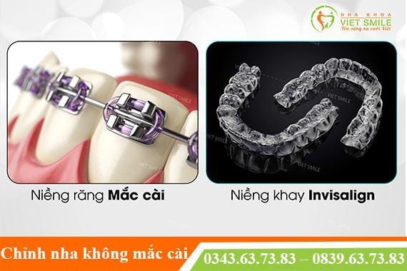 niềng răng trong suốt giá bao nhiêu?