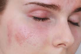 Da dễ kích ứng (allergy-prone skin)