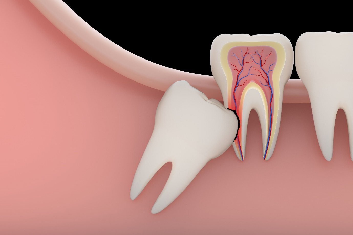 Nhổ răng khôn có ảnh hưởng gì?