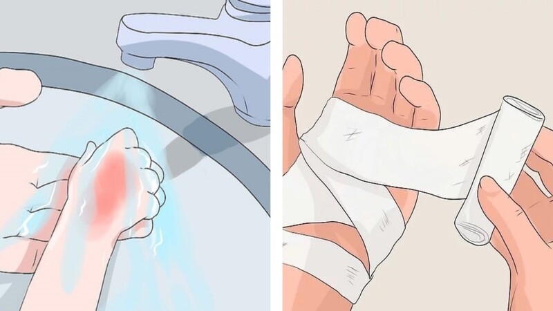 Cách xử lý vết thương khi bị bỏng