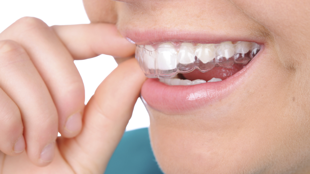 Làm trắng răng tự nhiên có gây hại cho răng của bạn không?