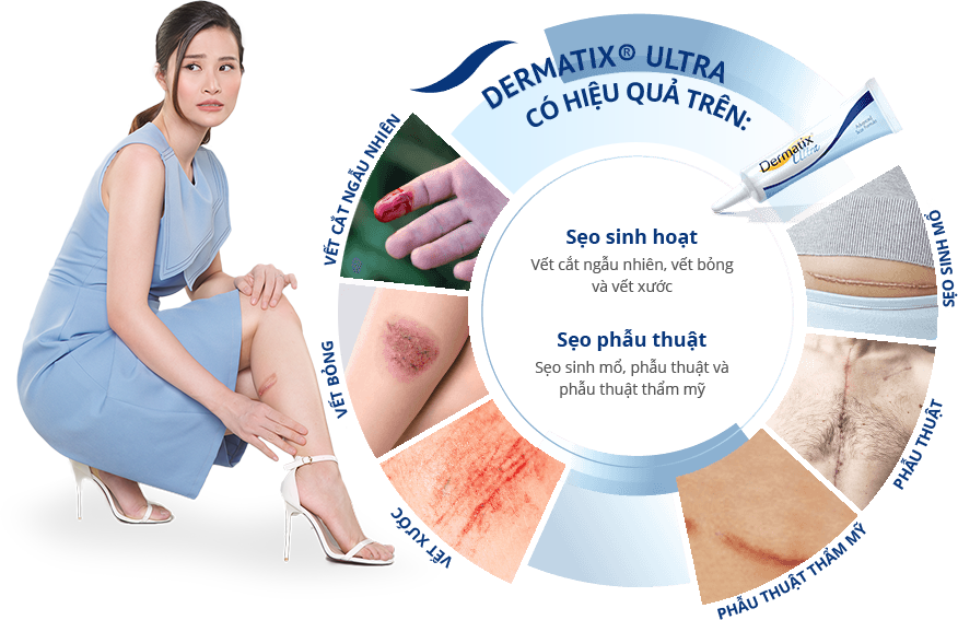 Dermatix® Ultra liệu có an toàn, hiệu quả cho cả sẹo sinh mổ? 