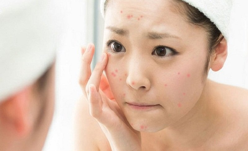 Cách chăm sóc da sau nặn mụn đúng cách và hiệu quả