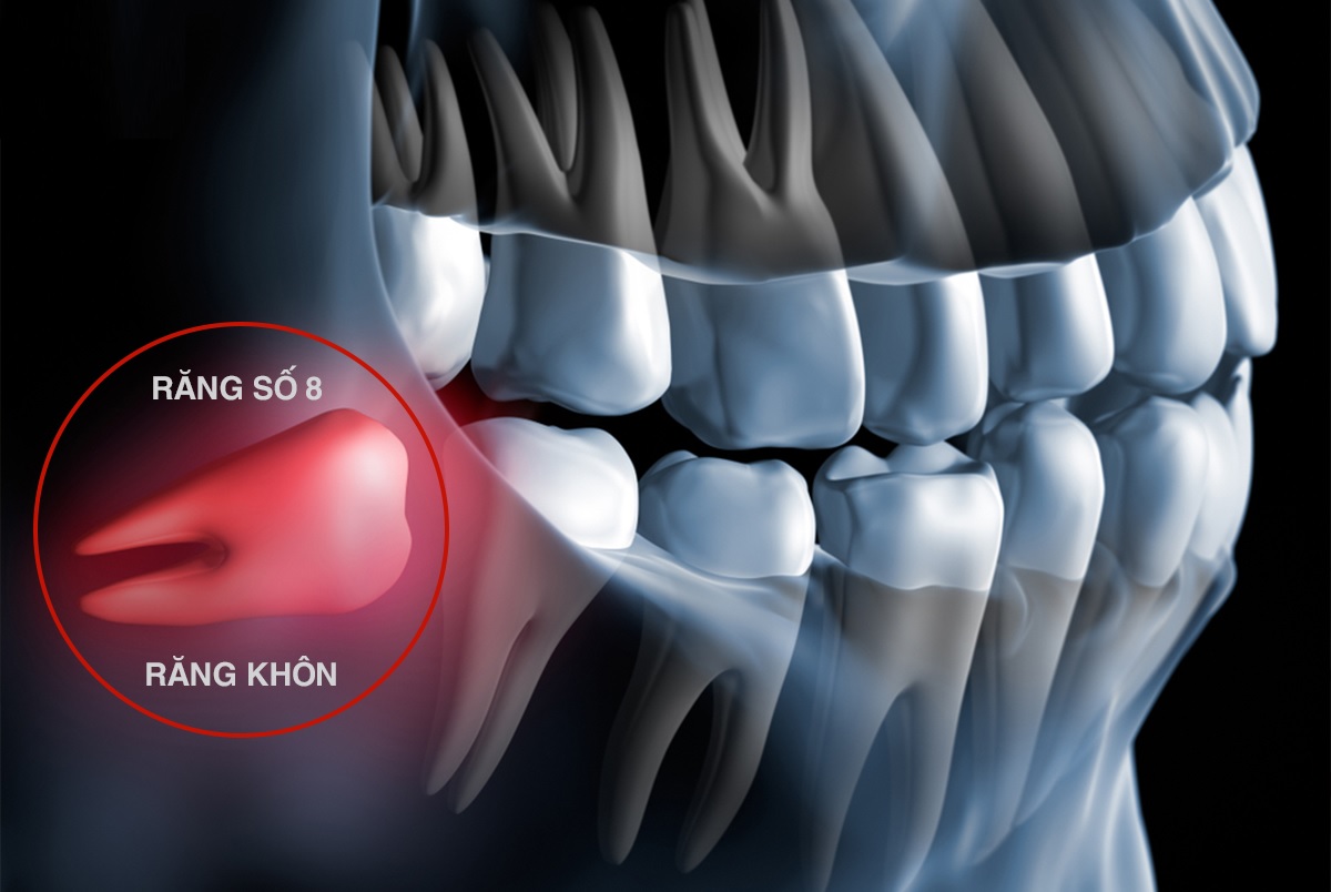 Răng khôn là gì?